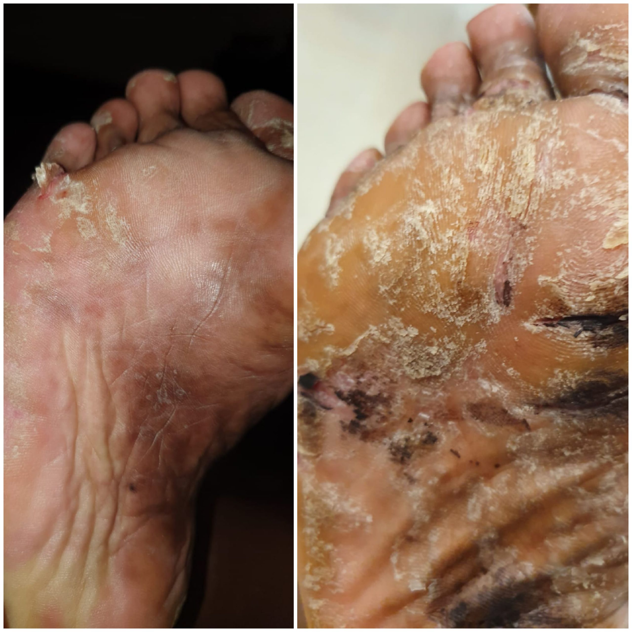 לפני ותוך התהליך פסוריאזיס בכפות הרגליים